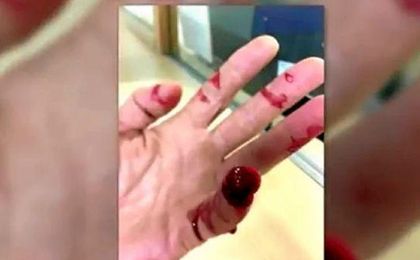 Así ha quedado la mano del agente. Así ha quedado la mano del agente.